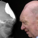 Illustration for article titled Mans Skull Grows Back After 50 Years